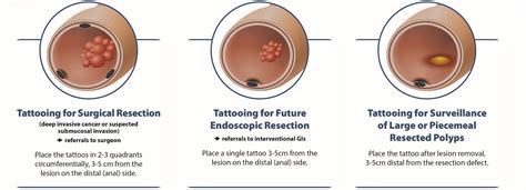 tattoo in anus|Endoscopic tattooing of colorectal lesions: Is it a risk.